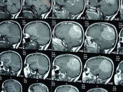 Benghazi Brain tumour surgery offers hope for cancer patients