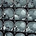 Benghazi Brain tumour surgery offers hope for cancer patients